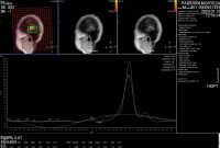 برای اولین بار در گیلان؛ راه اندازی MRI پیشرفته بررسی ضایعات مغزی در مرکز آموزشی و درمانی پورسینا